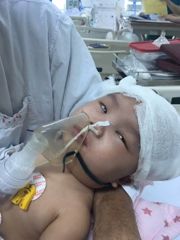 Ngã võng, bé gái 6 tháng tuổi bị chấn thương sọ não nguy kịch Nga vong, be gai 6 thang tuoi bi chan thuong so nao nguy kich