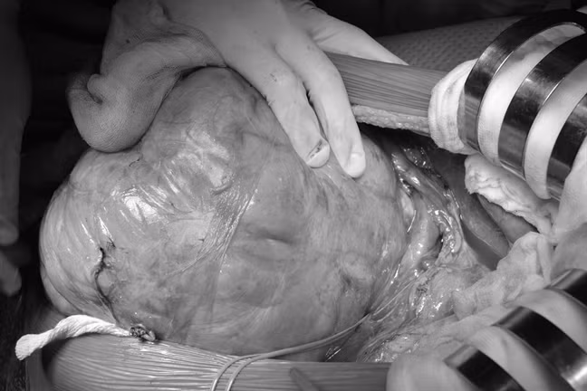 Kinh hoàng bướu thận nặng 4 ký nằm trong bụng hơn 2 năm Kinh hoang buou than nang 4 ky nam trong bung hon 2 nam