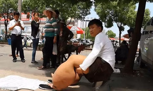 Bị chứng chân voi nặng 150 kg chỉ vì bị... muỗi đốt Bi chung chan voi nang 150 kg chi vi bi... muoi dot