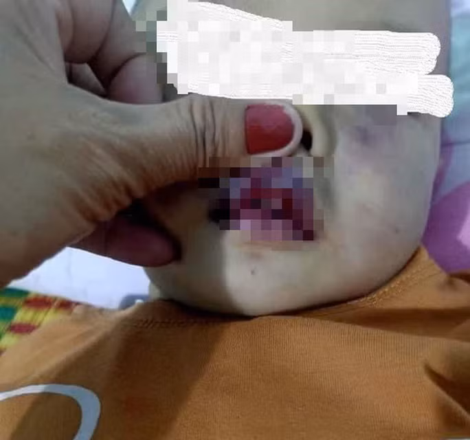 Nghi van diem giu tre khong phep bao hanh da man tre 18 thang tuoi-Hinh-2