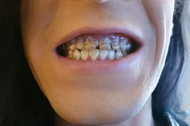 Kinh hãi những tai biến khủng khiếp vì thói quen uống nước tăng lực - Hình 2 Kinh hai nhung tai bien khung khiep vi thoi quen uong nuoc tang luc-Hinh-2