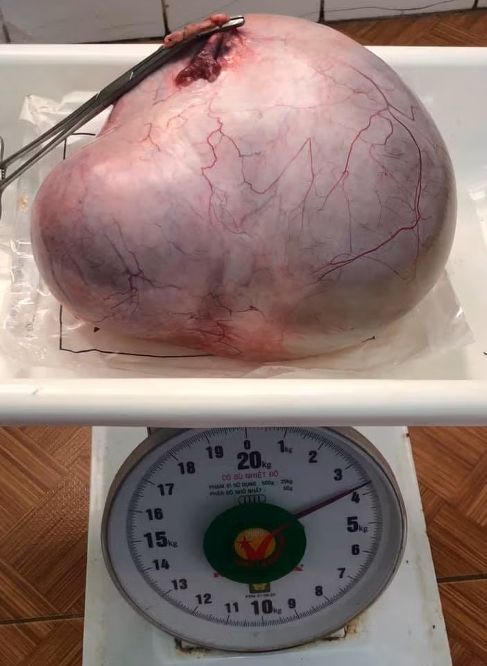 Kinh hoàng cụ bà U70 mang quái u gần 4kg chứa bã đậu, xương và tóc - Hình 2 Kinh hoang cu ba U70 mang quai u gan 4kg chua ba dau, xuong va toc-Hinh-2