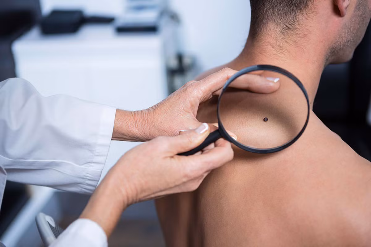 Thay đổi màu da: Khi thấy sự thay đổi trong kích thước, hình dạng, hoặc màu sắc của nốt ruồi hoặc các vết khác trên da, hãy gặp bác sĩ càng sớm càng tốt. Những vết mới xuất hiện hoặc bị biến đổi rất có thể là dấu hiệu ban đầu của bệnh ung thư da.