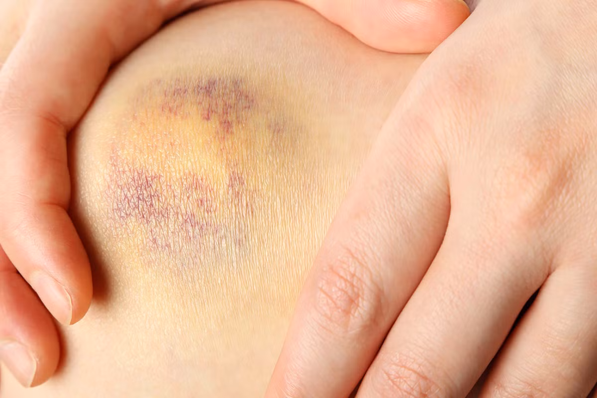 Bầm tím quá mức: Những vết bầm tím bất thường có thể là một triệu chứng bệnh bạch cầu, theo Trung tâm điều trị ung thư của Mỹ. 