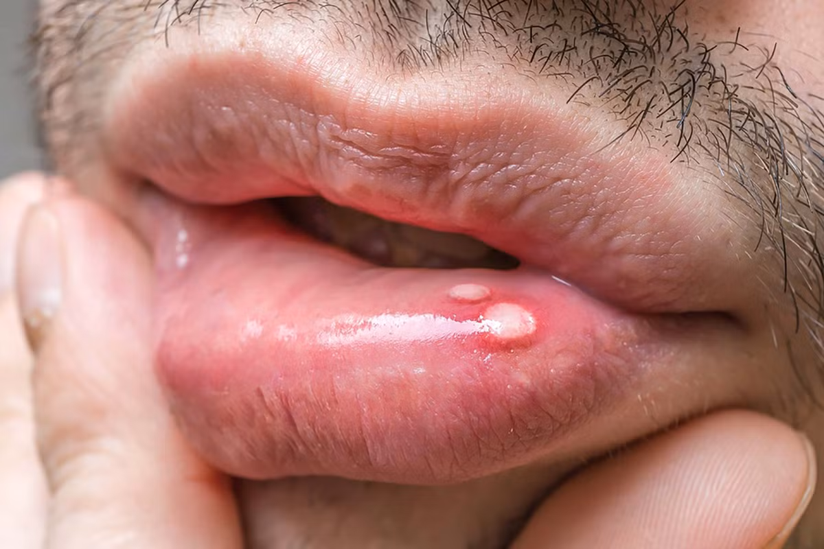 Lở loét hoặc đau ở miệng: Những vét loét miệng thường không đáng lo ngại. Tuy nhiên nếu bạn nhận thấy vết loét không lành, các mảng trắng hoặc đỏ trên nướu răng hoặc lưỡi và sưng hoặc tê hàm thì đó có thể là dấu hiệu của một số bệnh ung thư miệng.