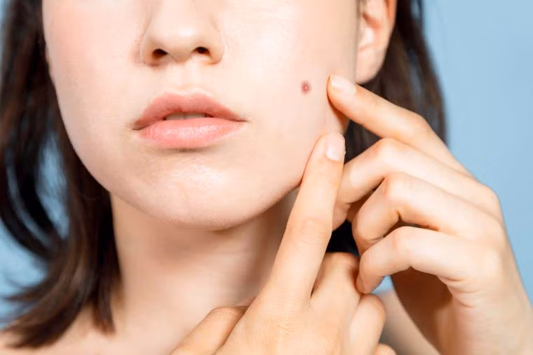Nước gừng cũng giúp bạn giảm mụn, các nốt sưng đỏ và hạn chế tái phát mụn trong tương lai.