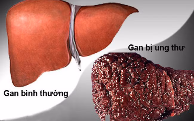 Để ý triệu chứng '2 ngứa 1 đen' trên cơ thể, báo hiệu ung thư gan đến gần De y trieu chung '2 ngua 1 den' tren co the, bao hieu ung thu gan den gan