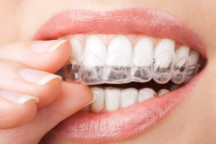 Trám chân răng: Nếu bạn đã trám chân răng, bạn có thể nên xem xét một chất trám bảo vệ răng khỏi vi khuẩn.