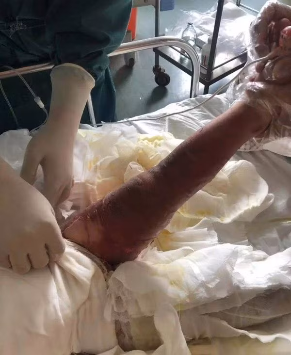 Bé ngã vào chảo dầu sôi, hành động của cha mẹ hóa ra hại con - Hình 2 Be nga vao chao dau soi, hanh dong cua cha me hoa ra hai con-Hinh-2