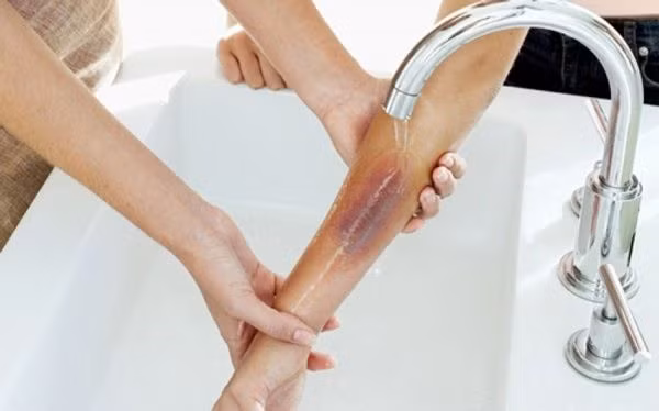 Bé ngã vào chảo dầu sôi, hành động của cha mẹ hóa ra hại con - Hình 3 Be nga vao chao dau soi, hanh dong cua cha me hoa ra hai con-Hinh-3