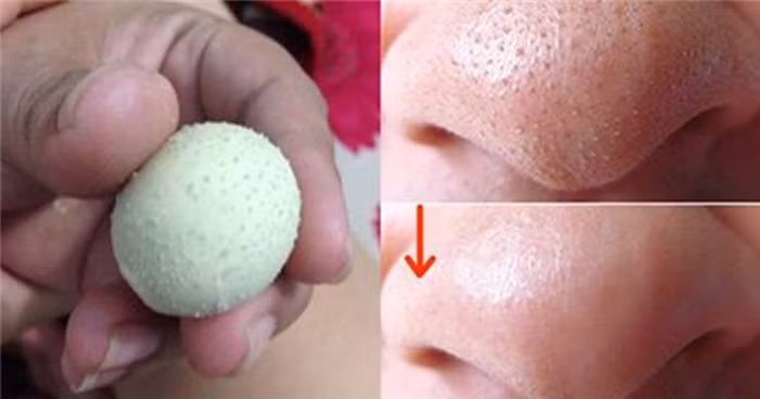 Đơn giản hơn, bạn có thể luộc trứng gà, bóc vỏ, sau đó bọc trong một miếng vải và lăn khắp vùng mũi bị mụn đầu đen cho đến khi trứng nguội hẳn. Do hơi nóng của trứng, nhân mụn đầu đen sẽ được hút hết ra ngoài.