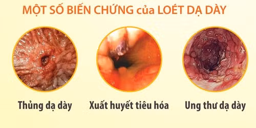 Benh loet da day cua NS Mac Can nguy hiem the nao-Hinh-2