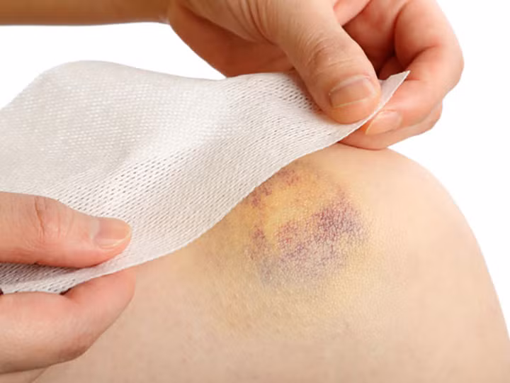 Dễ bị bầm tím: Ít nhất một lần trong đời, tất cả chúng ta đều đã trải qua chấn thương bầm dập. Nhưng một người có hàm lượng vitamin K thấp hơn bị bầm tím có thể dẫn đến xuất huyết quá mức do thiếu vitamin K.