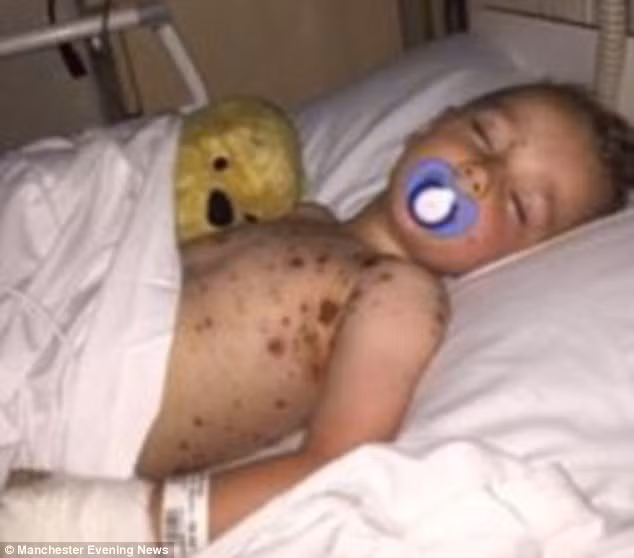 Bé Lewis được nhập viện trong tình trạng nhiễm trùng máu nặng. Các bác sĩ Bệnh viện Nhi Alder Hey đã điều trị kịp thời và giúp bé vượt qua cơn nguy kịch. 