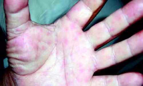 Mùa nóng: Đừng nhầm lẫn viêm màng não mô cầu với cháy nắng Mua nong: Dung nham lan viem mang nao mo cau voi chay nang