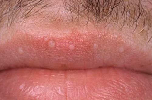 Nốt sùi mào gà cũng có thể mọc trên môi người nhiễm bệnh. Đây là hình ảnh thời điểm giai đoạn đầu của bệnh. Ảnh: PKbenhxahoi.