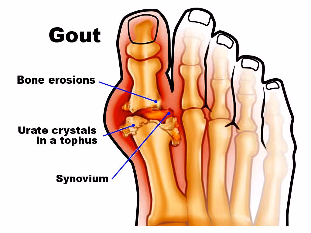 Quả cây trứng cá giảm đau cho bệnh nhân Gout: nếu chỉ sử dụng trứng cá sẽ không thể chữa khỏi hoàn toàn bệnh Gout nhưng ănquả cây trứng cá đều đặn 9-12 quả mỗi ngày có thể giảm nhẹ cơn đau do bệnh gout gây ra. Ảnh: Nấm lim xanh. 