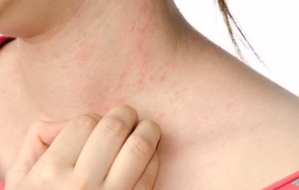 Các tác dụng phụ này có thể gây ảnh hưởng đến khả năng thực hiện các hoạt động hàng ngày, nhưng sẽ biến mất sau một thời gian ngắn. Một số người không có tác dụng phụ.