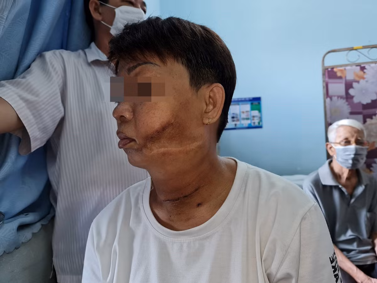 U lớn tuyến giáp kết hợp u máu đẩy khí quản và thực quản sang phải - Hình 2 U lon tuyen giap ket hop u mau day khi quan va thuc quan sang phai-Hinh-2