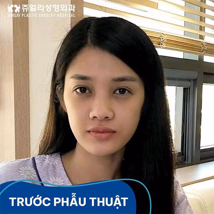 Trình Mỹ Duyên “lột xác” sau phẫu thuật thẩm mỹ Trinh My Duyen “lot xac” sau phau thuat tham my