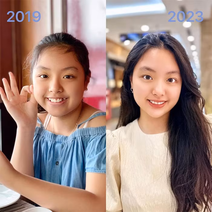 "Bí kíp dậy thì thành công của nàng Suti là đây. Tục ngữ có câu "Cái răng cái tóc là góc con người" quá chuẩn nhỉ. Nàng Suti 4 năm trước khi chuẩn bị niềng răng và chưa dậy thì. Sau gần 4 năm niềng răng thì bây giờ nàng đã có diện mạo khác hẳn với hàm răng xinh. Hàm răng gọn cũng giúp xương hàm nhỏ lại và mặt dài hơn đấy nhé…", Thúy Hạnh chia sẻ.