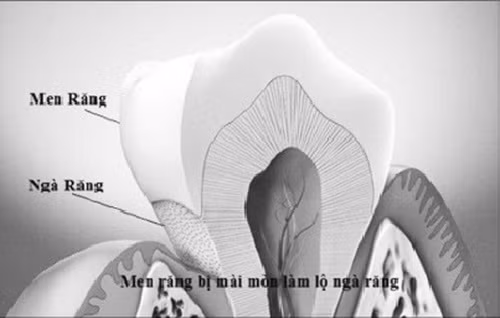 Cách trị dứt điểm chứng ê buốt chân răng Cach tri dut diem chung e buot chan rang