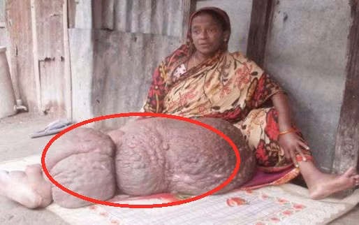 Chân khổng lồ gần 60 kg khiến người phụ nữ liệt suốt 18 năm Chan khong lo gan 60 kg khien nguoi phu nu liet suot 18 nam