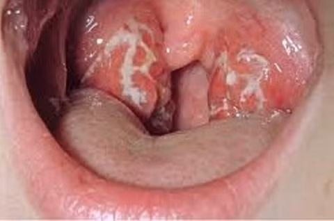 Bệnh bạch hầu khiến 3 người tử vong nguy hiểm thế nào? - Hình 2 Benh bach hau khien 3 nguoi tu vong nguy hiem the nao?-Hinh-2