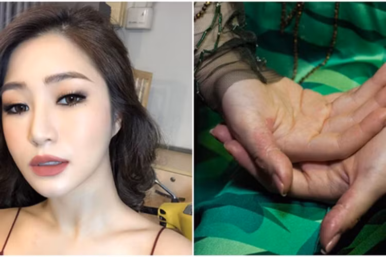 Do thường xuyên rơi vào tình trạng căng thẳng, Hương Tràm tự bóc da tay đến mức chảy máu Ảnh: Thế giới trẻ