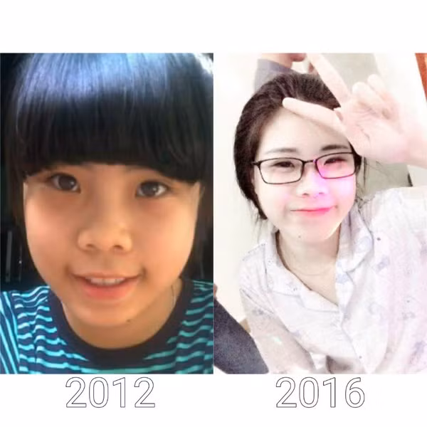 Chỉ sau 4 năm cô bạn này đã có làn da trắng mịn, khuôn mặt bầu bĩnh dễ thương như thế này.