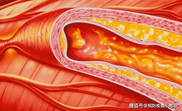 Gần đây, Vương chú ý nghỉ ngơi hơn song thể trạng không cải thiện nhiều. Lo lắng, người nhà vội đưa cô đi khám. Kết quả kiểm tra cho thấy, mỡ máu của Vương khá cao. Nếu để lâu, cơ thể dễ đối diện các bệnh tim mạch, mạch máu não như nhồi máu não, xuất huyết não nguy hiểm. Trường hợp xấu, tình trạng có thể đe dọa tính mạng người bệnh.