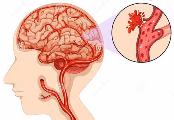 Xuất huyết não được mệnh danh là "kẻ giết người nhanh nhất", nguyên nhân dẫn đến sự ra đi của nhiều người trung niên, cao tuổi. Để giảm thiệt hại do căn bệnh, bạn cần hết sức chú ý đến dấu hiệu xuất huyết não sau: