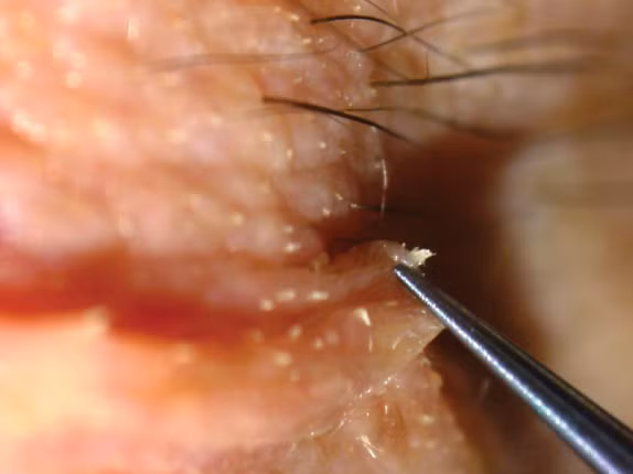 Cận cảnh một con ký sinh trùng Demodex trong da của con người. (Nguồn Boredom Therapy)