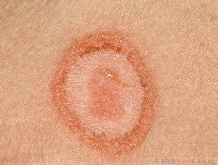 Các hình ô van này còn được gọi là săng giang mai thường có kích thước từ 0,5-2cm, khi rửa sạch sẽ nhìn thấy đáy không bằng phẳng, màu đỏ tươi, nền cứng, ấn vào không đau. Sau đó khoảng 1 tuần sẽ xuất hiện sự sưng đau của hạch.