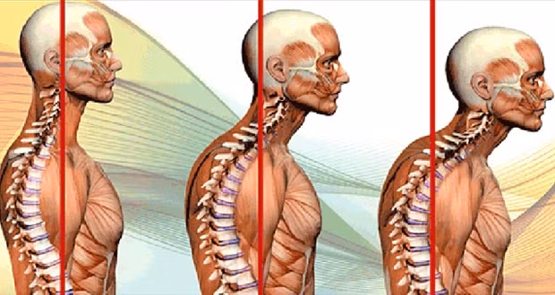 Hai vai co lại quá lâu sẽ khiến hệ thống cơ ở lưng trên bị giãn quá tải còn cơ ngực thì bị ép chặt. Tư thế này còn có thể chèn ép vào đám rối thần kinh cánh tay, mạng lưới các dây thần kinh bắt nguồn từ cổ lan xuống khu vực nách và cánh tay, gây ra hiện tượng tê tay.