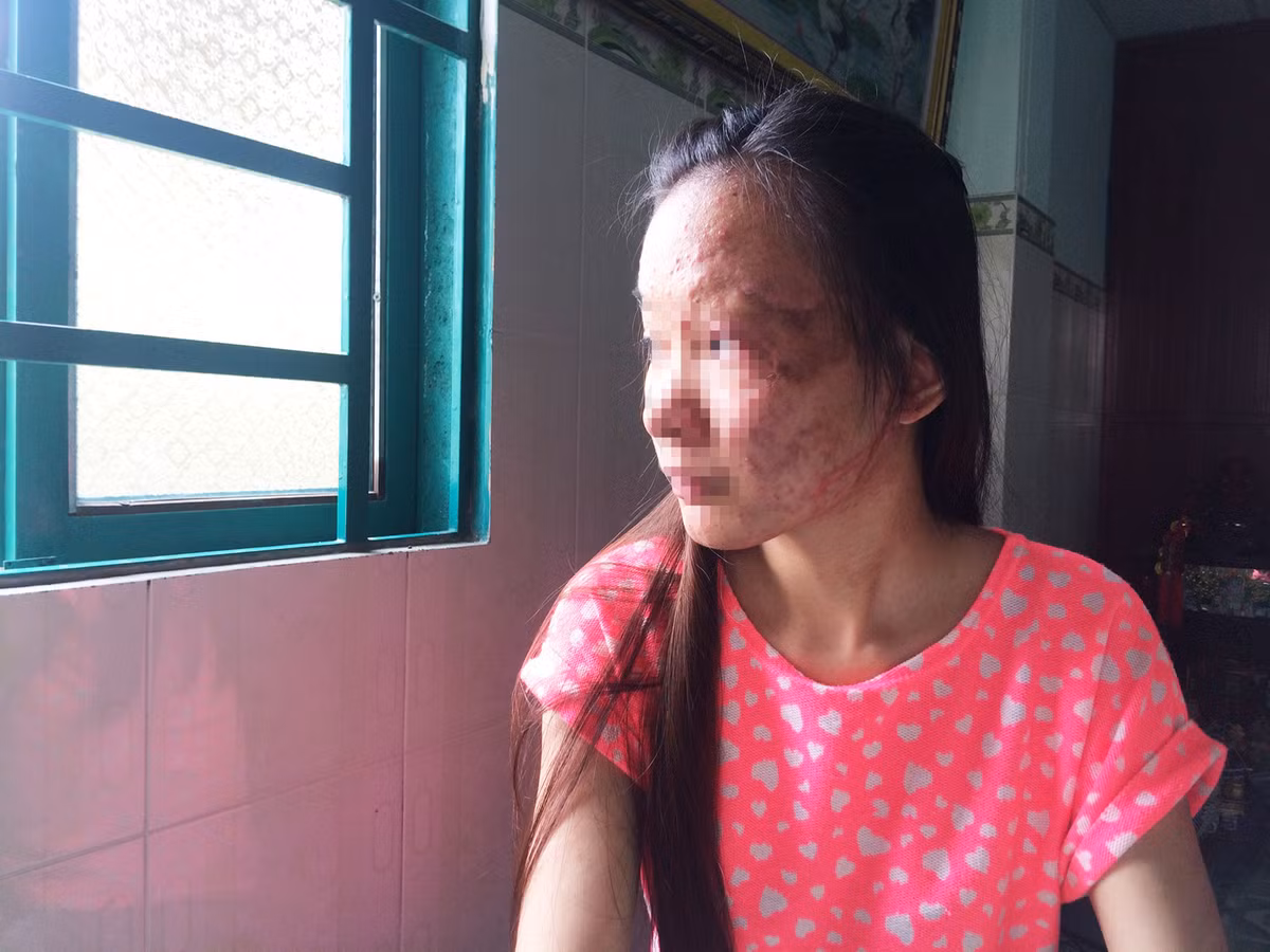 Nạn nhân bị dính axit thường bị chấn động về mặt tâm lí, hủy hoại thân thể và khiến họ không thể hòa nhập với xã hội. Phụ nữ bị tạt axit thậm chí còn đáng sợ hơn. Ngoài việc nhan sắc bị hủy hoại, họ còn rất khó tìm việc làm và lấy chồng.
