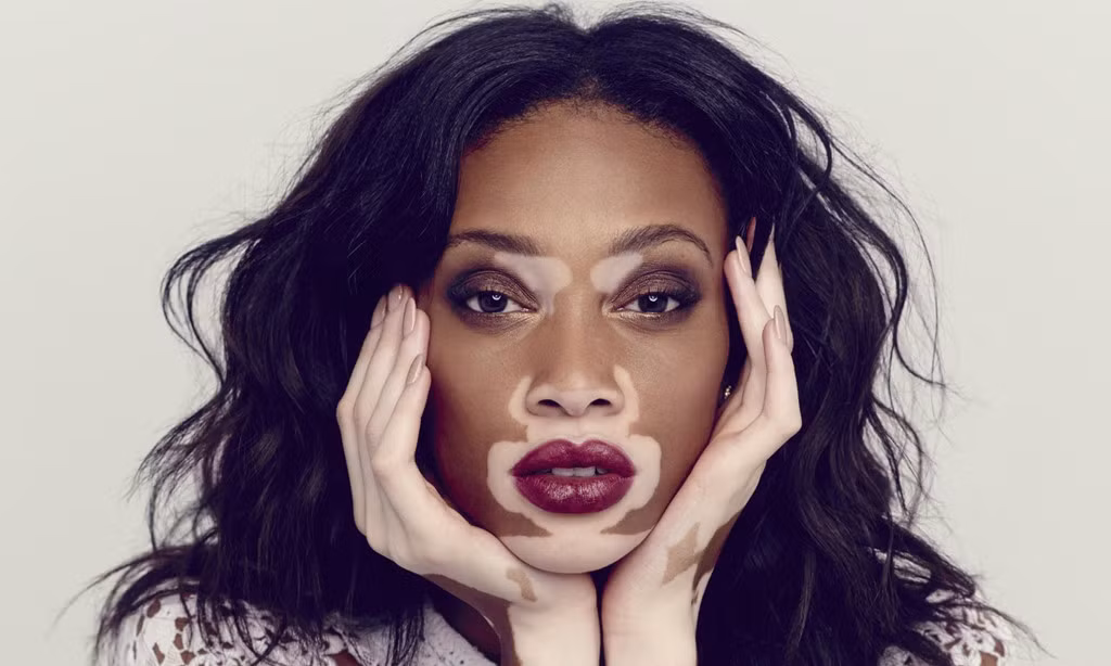 Winnie Harlow là cái tên quen thuộc của làng thời trang thế giới. Giữa vô số người mẫu sở hữu vẻ đẹp chuẩn mực, cô gái 24 tuổi trở thành hiện tượng lạ bởi làn da bạch biến, loang lổ khắp cơ thể. Điều này khiến cô bị người khác gọi là bò, ngựa vằn và nhiều lần có ý định tự sát. Sau khi vượt qua mặc cảm, cô quyết tâm chứng minh giá trị bản thân bằng cách tham gia America's Next Top Model 2014, để lại ấn tượng với khán giả bằng kỹ năng người mẫu chuyên nghiệp.