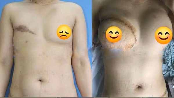 Người phụ nữ nhiều năm phải nhét giẻ vào ngực vì...ung thư vú Nguoi phu nu nhieu nam phai nhet gie vao nguc vi...ung thu vu