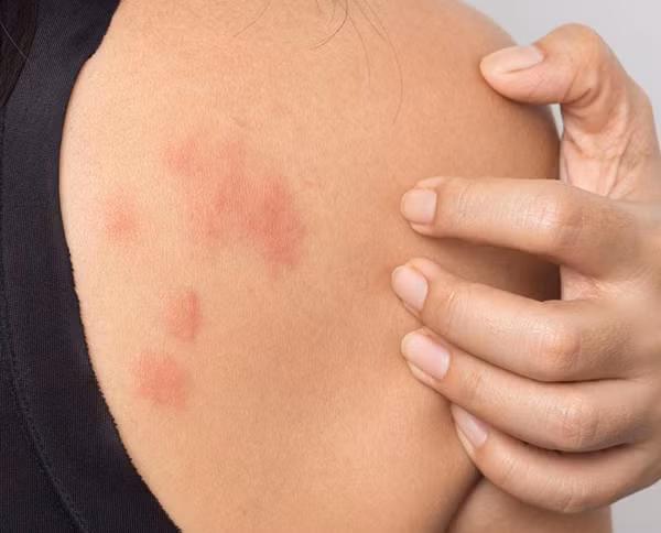 Thực tế, lượng formaldehyde được tìm thấy ở loại vải không nhăn khó có khả năng gây khó chịu với hầu hết mọi người. Vậy nhưng, tùy vào cơ địa, người có tiền sử dị ứng có thể đối diện viêm da. Biểu hiện của dị ứng formaldehyde là tình trạng mọc ban, mụn nước, da bong tróc, khô, ngứa. (Ảnh minh họa)