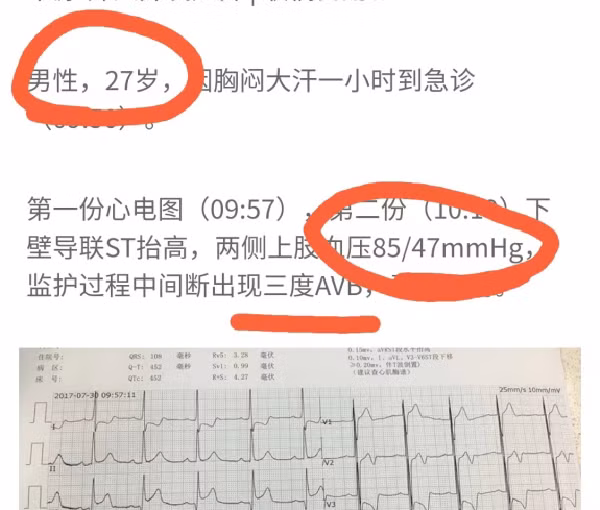 Trang Sohu (Trung Quốc) thông tin, một chàng trai bất ngờ bị nhồi máu cơ tim, đột tử khi mới 27 tuổi. Ban đầu, bệnh nhân lên cơn đau tức ngực nên người nhà đưa đến viện khám. Dù được bác sĩ điều trị tích cực song tình trạng đau tức ngực, khó thở, choáng, toàn thân đau đớn... ngày càng diễn biến xấu. Sau 20 tiếng vật lộn với cơn đau, chàng trai trút hơi thở cuối cùng trước sự ngỡ ngàng, đau đớn của người thân. (Ảnh: Sohu)