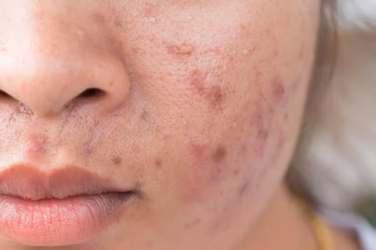 8. Bạn “nghiện” đồ ngọt Các chuyên gia cho biết việc ăn quá nhiều đường có thể khiến da xỉn màu và nhăn nheo. Khi bạn thưởng thức hương vị kem, bánh và kẹo yêu thích của mình, các phân tử đường liên kết với protein trong da, gây tổn thương cho các sợi collagen giữ cho da săn chắc và đàn hồi, tạo ra các nếp nhăn và chảy xệ.