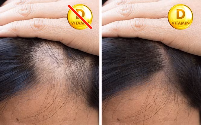 7. Rụng tóc Thiếu vitamin D khiến tóc bị suy yếu, mỏng và dễ bị rụng, khó phục hồi tóc. Vitamin D đóng một phần không thể thiếu trong quá trình tăng trưởng của tóc và nó có thể được sử dụng như một chất bổ sung nhằm điều trị rụng tóc.
