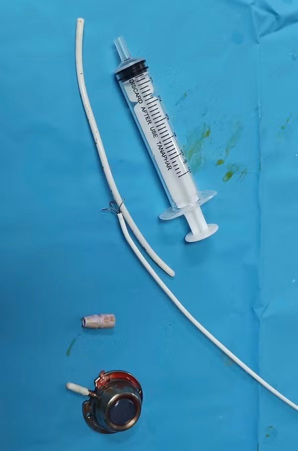 Lấy mảnh dị vật trong tim bệnh nhân suốt 6 năm Lay manh di vat trong tim benh nhan suot 6 nam