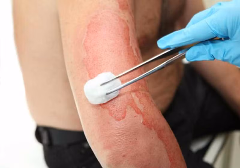 Xử lý vết bỏng: Dựa vào mức độ nghiêm trọng của vết bỏng, nếu bị bỏng độ ba (da đen hoặc khô) và vùng bỏng lớn hơn 7cm, hoặc bỏng xảy ra ở tay, chân, mặt, háng, khớp lớn... hãy gọi ngay cấp cứu. Khi mức độ bỏng nhẹ, bạn có thể sơ cứu bằng cách ngâm vùng bị ảnh hưởng trong 10-15 phút trong nước lạnh, sau đó phủ lớp mỏng gạc vô trùng lên vết thương.