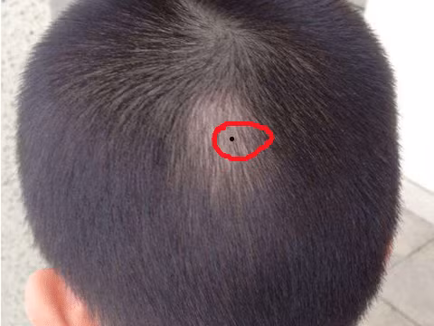  Nốt ruồi ở phía sau đầu: Người có nốt ruồi ở vị trí này là người bẩm sinh đã có phúc khí, mang mệnh quý nhân. Họ là người thích hợp làm những việc liên quan đến chính trị, quân sự. Ngoài ra, họ cũng là người cả đời không bao giờ phải lo lắng về chuyện tiền bạc, cả đời sống sung túc, giàu sang. Ảnh: sohu.com. 
