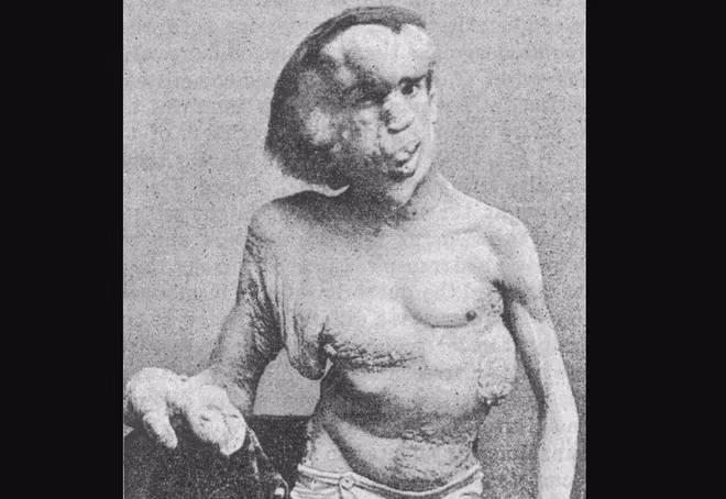 3. Joseph Merrick: Sinh năm 1862, Merrick bị rối loạn thể chất khiến chân tay phát triển to bất thường. Ông trở thành hiện tượng trong đoàn xiếc và được biết đến với biệt danh "người voi".