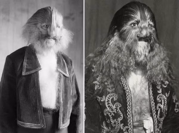 7. Stephan Bibrowsky (Lionel): Mắc chứng hypertrichosis, Lionel có cơ thể bao phủ bởi lớp lông dày và trở thành hiện tượng trong đoàn xiếc.