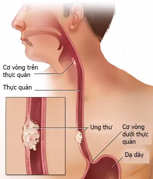 Chẩn đoán ung thư thực quản có thể dựa vào triệu chứng của bệnh kết hợp với chụp Xquang thực quản và các xét nghiệm khác. Nội soi kết hợp với sinh thiết, siêu âm là một biện pháp tốt để chẩn đoán sớm và chính xác bệnh này.