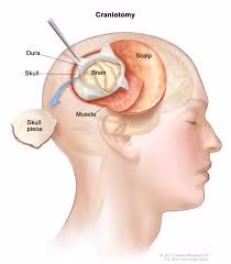 Ung thư não nguyên phát Gliobalastoma. Đây là dạng ung thư não nguyên phát thường gặp nhất. Bệnh này khá nguy hiểm và cần can thiệp y tế ngay lập tức.