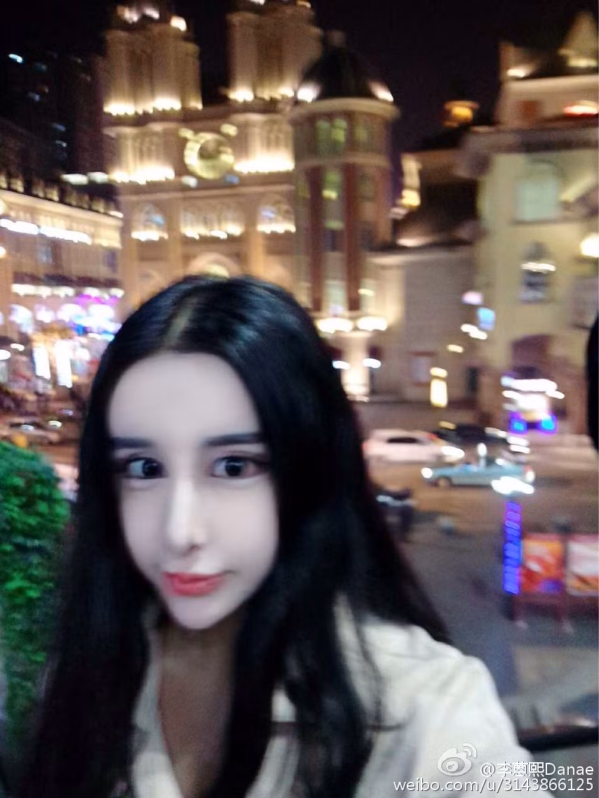 Khuôn mặt méo xệch của Lý Ân Hy sau khi làm phẫu thuật thẩm mỹ.